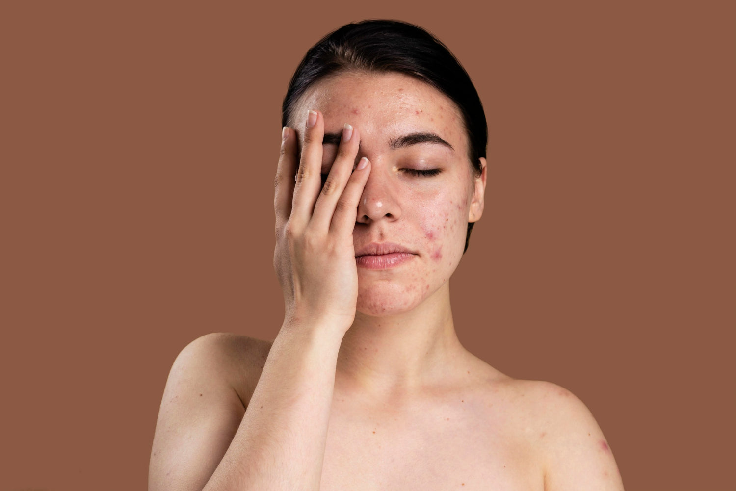 Acne & Blemishes