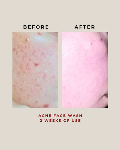 Acne Face Wash 100G