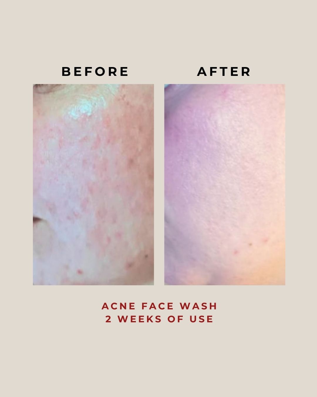 Acne Face Wash 100G
