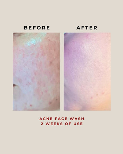 Acne Face Wash 100G