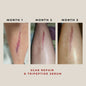 Before and after showing scar repair with a tripeptide serum over three months.